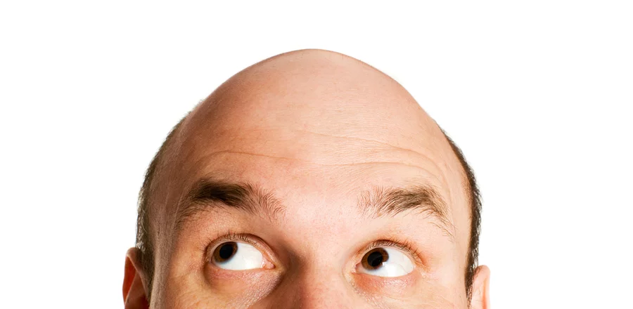 Ahairlosscurehair loss treatment do not fret little fella theres hope
