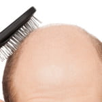 ahairlosscureHair diseases resulting into hair loss