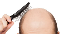 ahairlosscureHair diseases resulting into hair loss