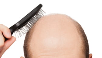 ahairlosscureHair diseases resulting into hair loss